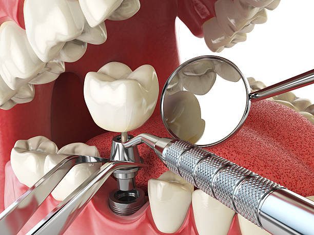 Best Emergency Tooth Extraction in South Deerfield, MA